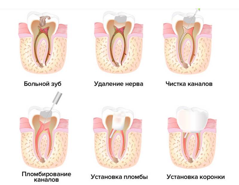 Лечение пульпита в Щёкино стоматология