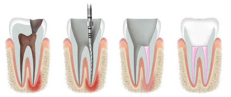Как лечат пульпит в стоматологии Щекино
