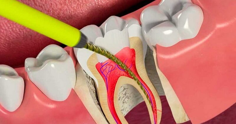 Как лечат пульпит в стоматологии Щекино
