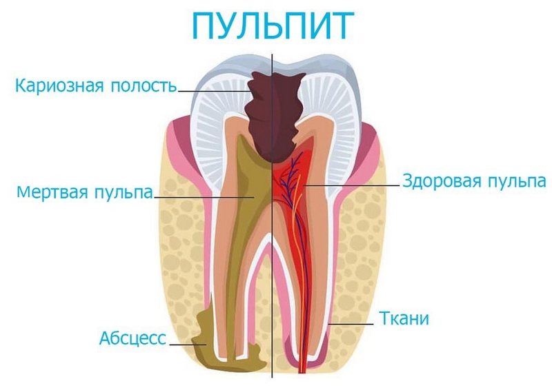 Пульпит зуба лечение в Щёкино