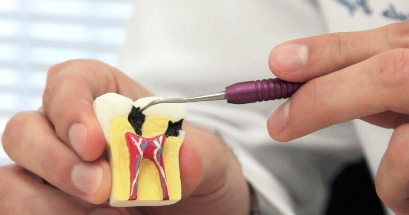 Пульпит зуба лечение в Щёкино